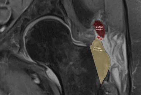 gluteus medius tears post op